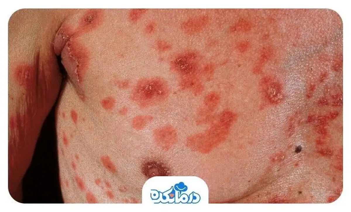 پمفیگوس فولیاسه چیست؟ علائم، علل و راه‌کارهای درمان آن