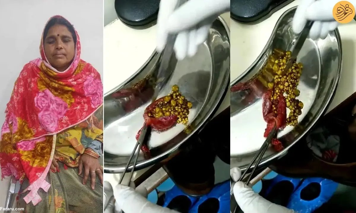 (ویدئو) خارج کردن ۳۸۲ سنگ از کیسه صفرای یک زن!