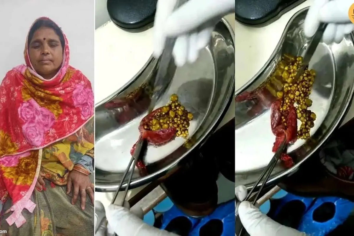 (ویدئو) خارج کردن ۳۸۲ سنگ از کیسه صفرای یک زن!