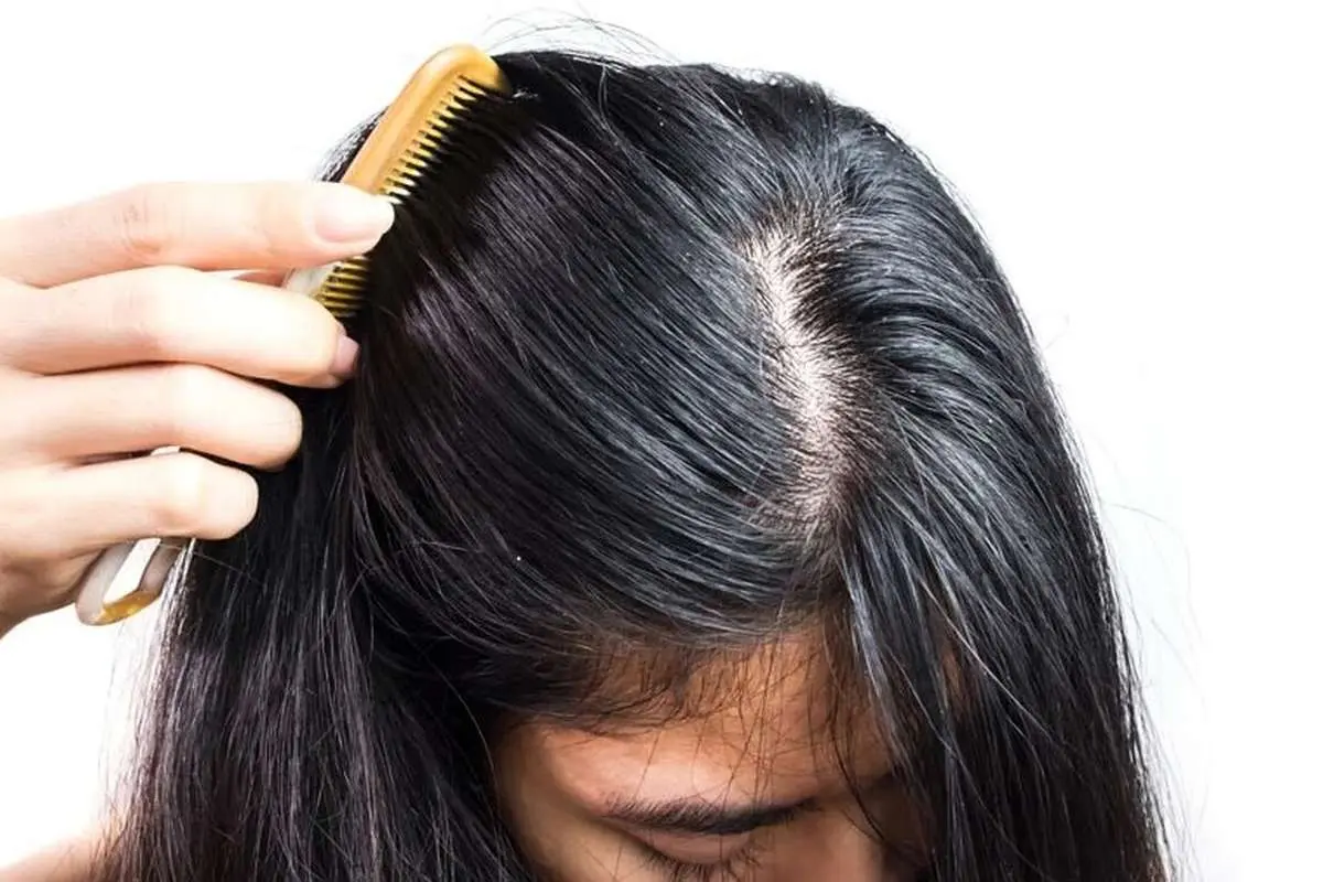 ۵ روش برای رهایی از چربی مو