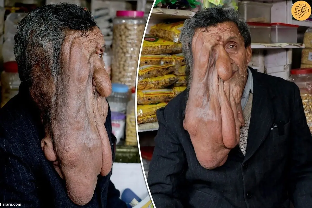 (ویدئو) چهره وحشتناک یک مغازه دار مبتلا به بیماری نادر
