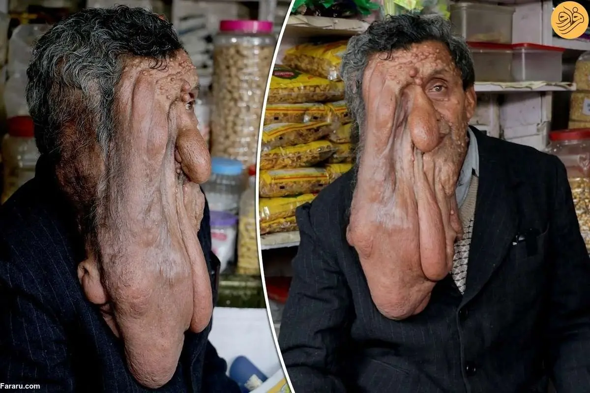 (ویدئو) چهره وحشتناک یک مغازه دار مبتلا به بیماری نادر