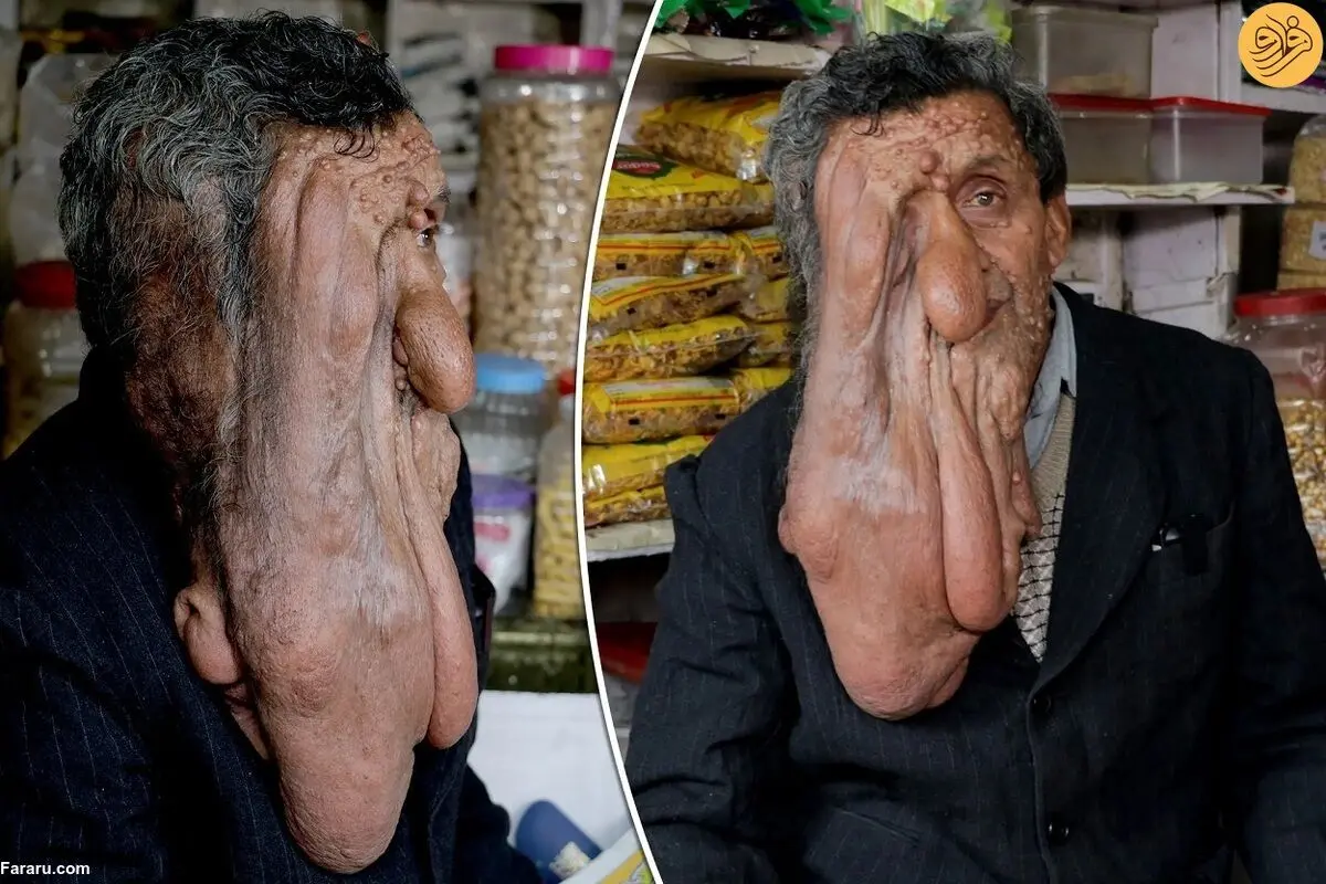 (ویدئو) چهره وحشتناک یک مغازه دار مبتلا به بیماری نادر