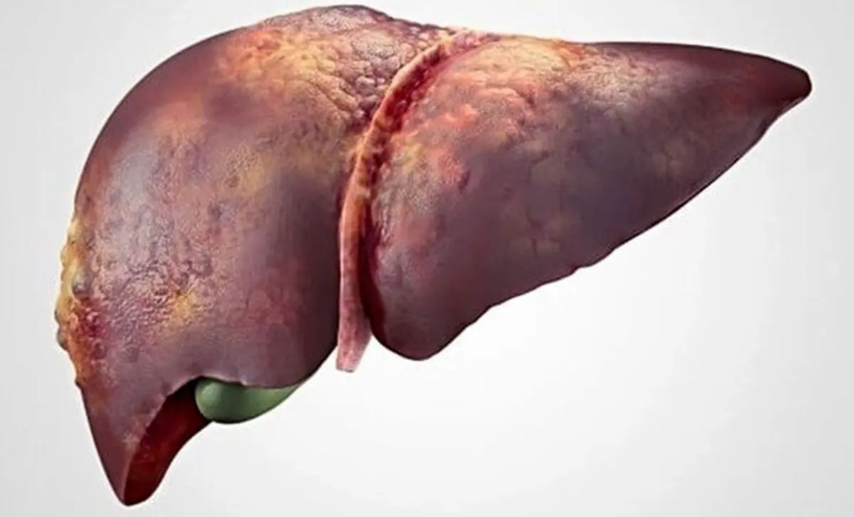 درمان کبد آسیب‌دیده با نانوذرات لیپیدی