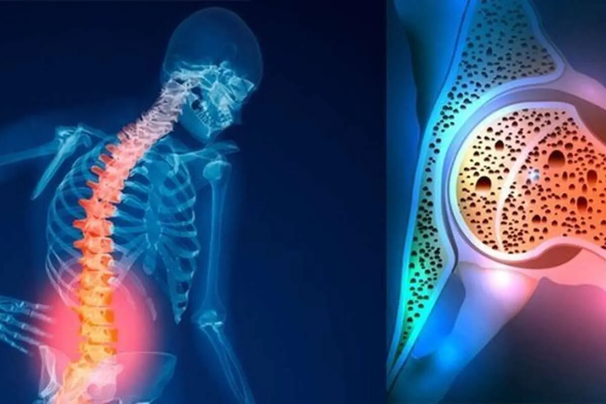 (ویدئو) چه کنیم که پوکی استخوان نگیریم؟