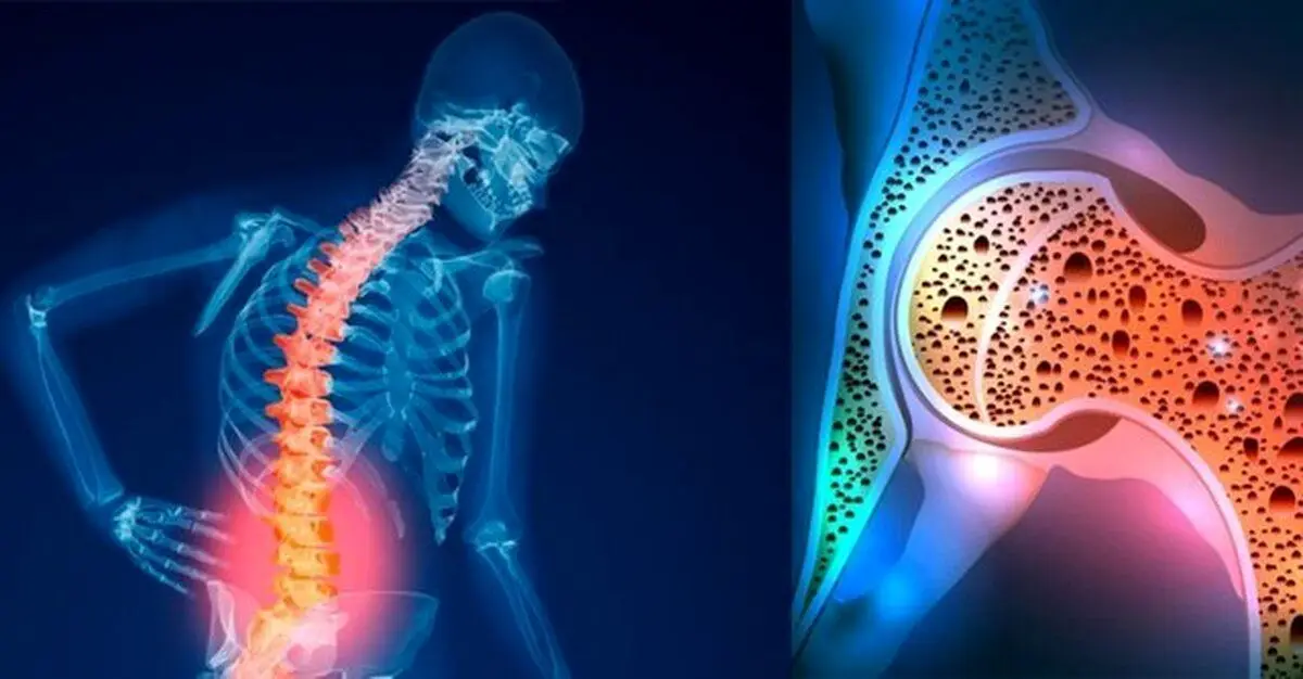 (ویدئو) چه کنیم که پوکی استخوان نگیریم؟