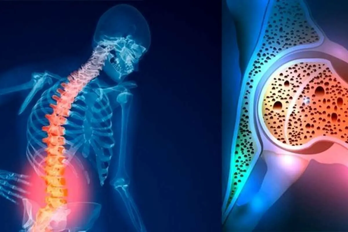 (ویدئو) چه کنیم که پوکی استخوان نگیریم؟
