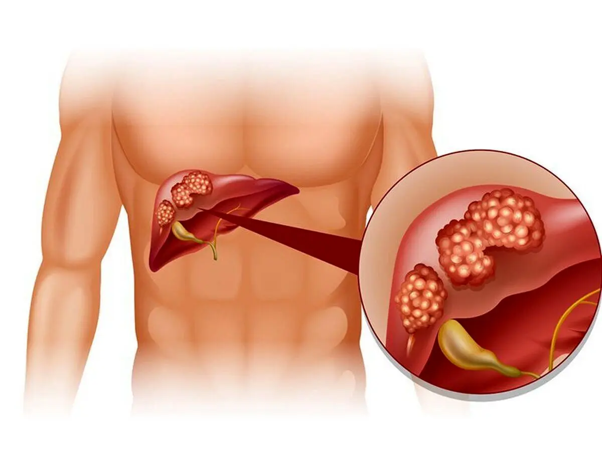 کیست کبد؛ علائم، علل، انواع، تشخیص و درمان