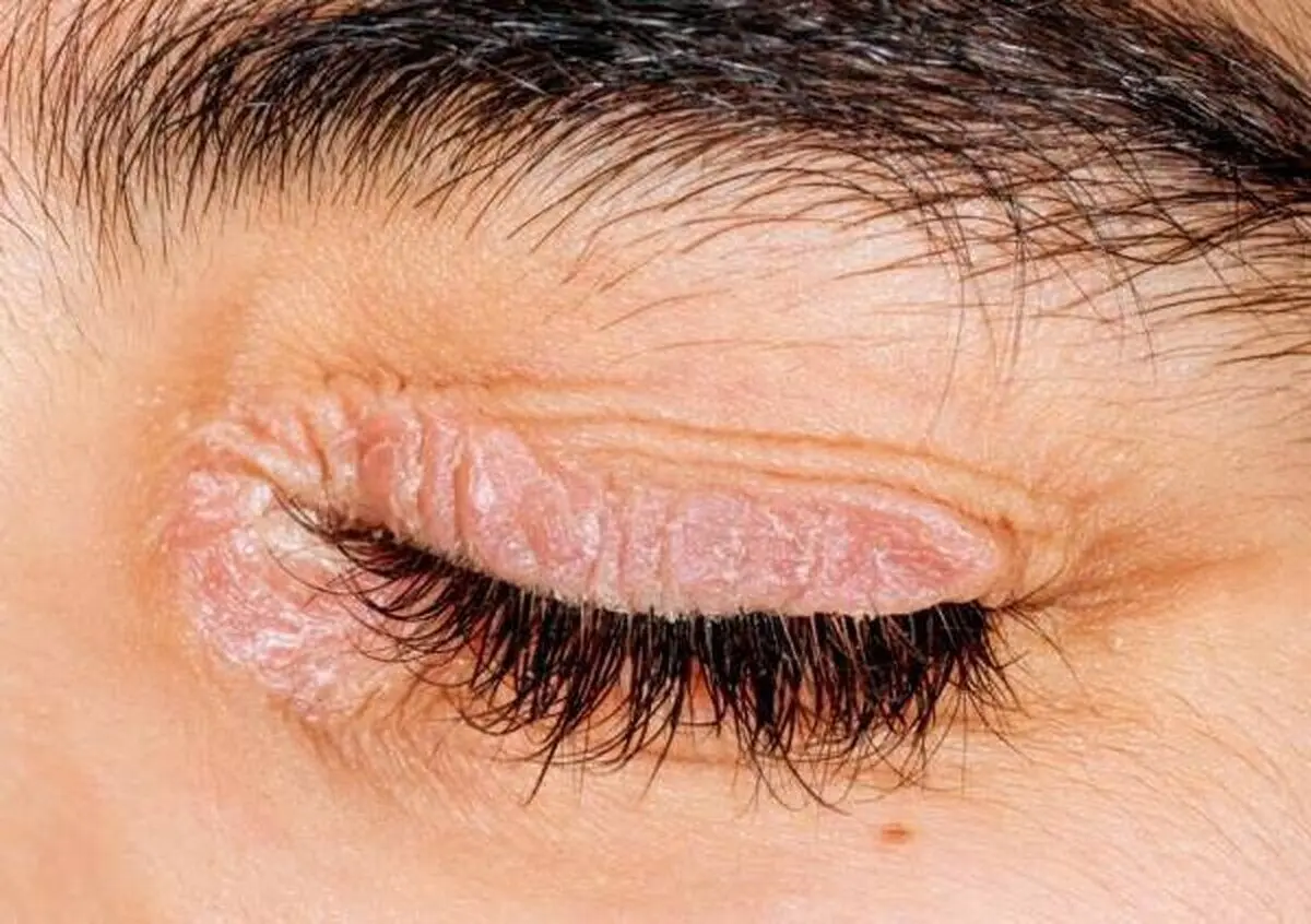 بیماری پسوریازیس چیست و چه علائمی دارد؟