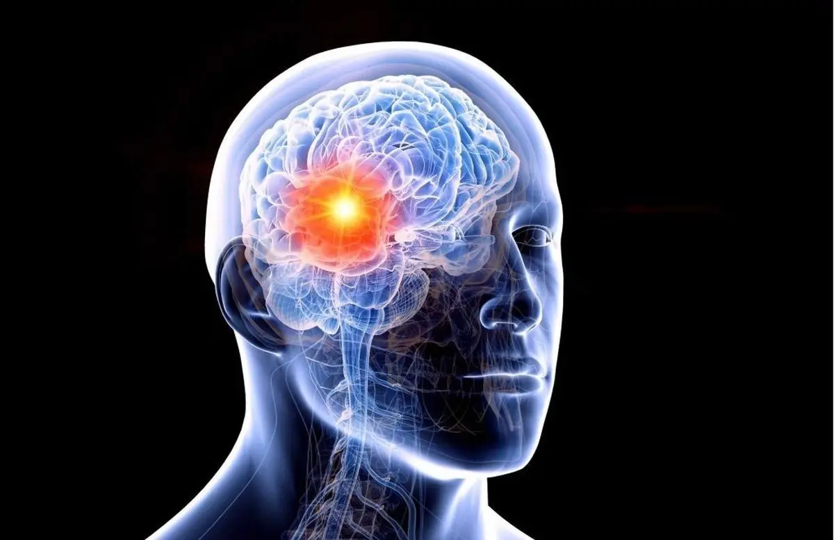 (ویدئو) پیشرفت عجیب علم؛ جراحی تومور بزرگ مغزی از راه بینی در ساری