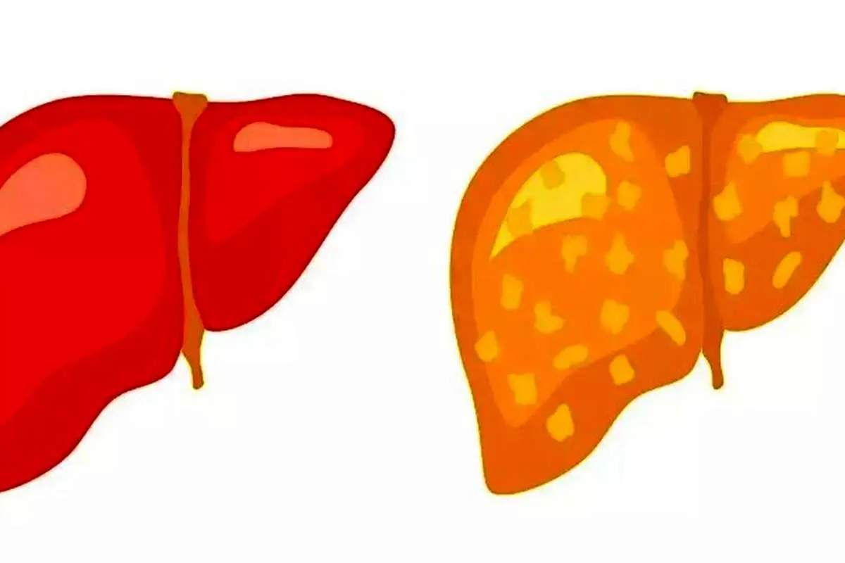 چرا به کبد چرب مبتلا می‌شویم؟