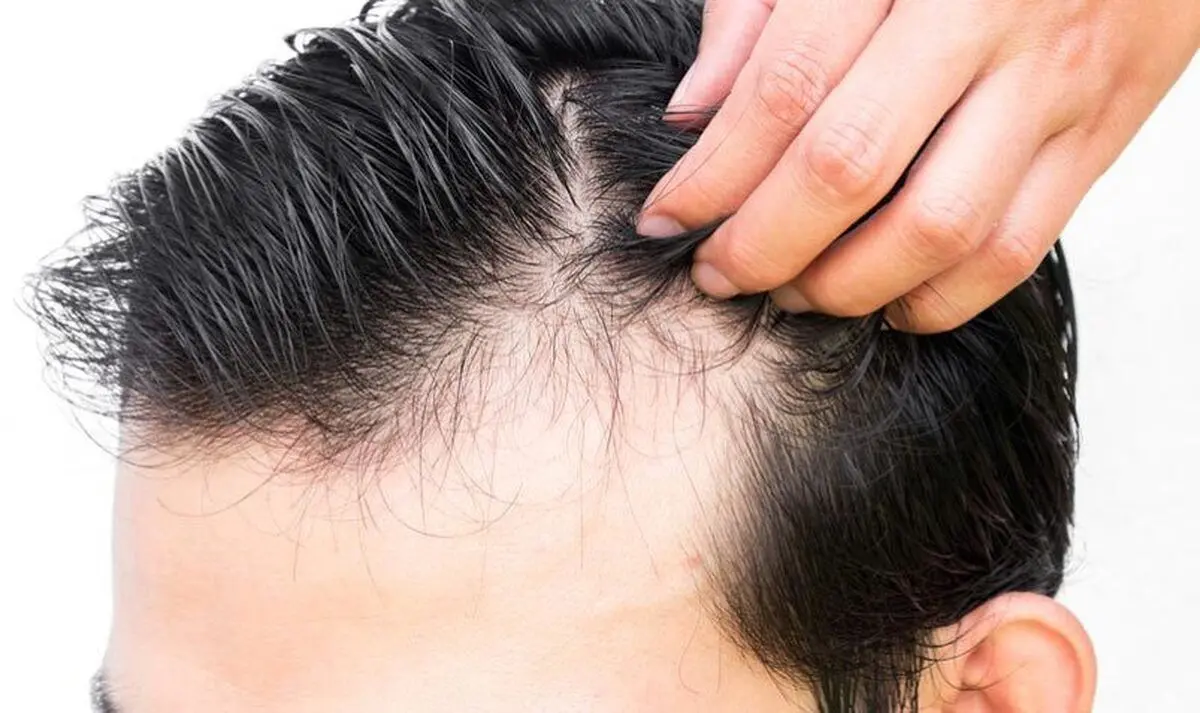 مکمل «بیوتین» در جلوگیری از ریزش مو موثر است؟