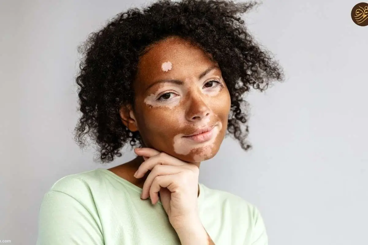 ویتیلیگو، بیماری پوستی عجیب و غریب چیست؟