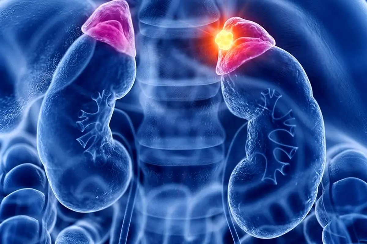 هیپرآلدوسترونیسم: علائم، علل، تشخیص و درمان