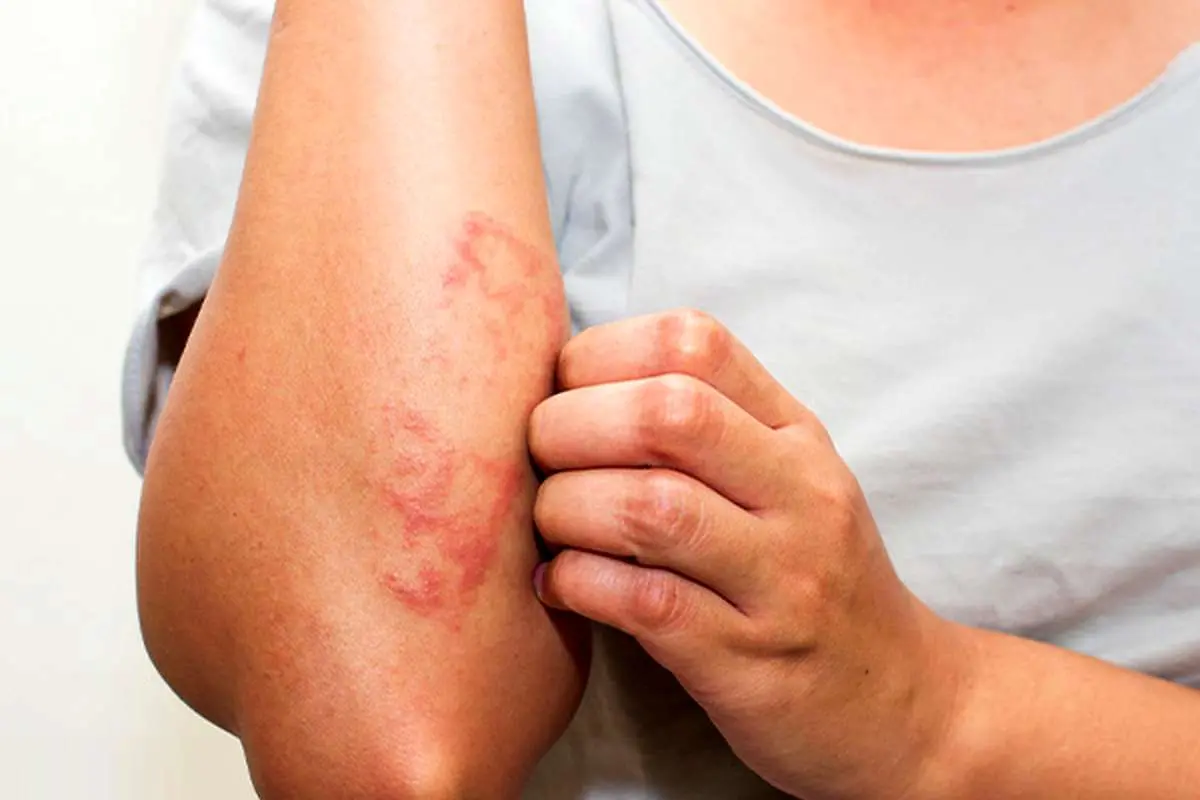 واکنش پوستی آلرژیک به عفونت پوست