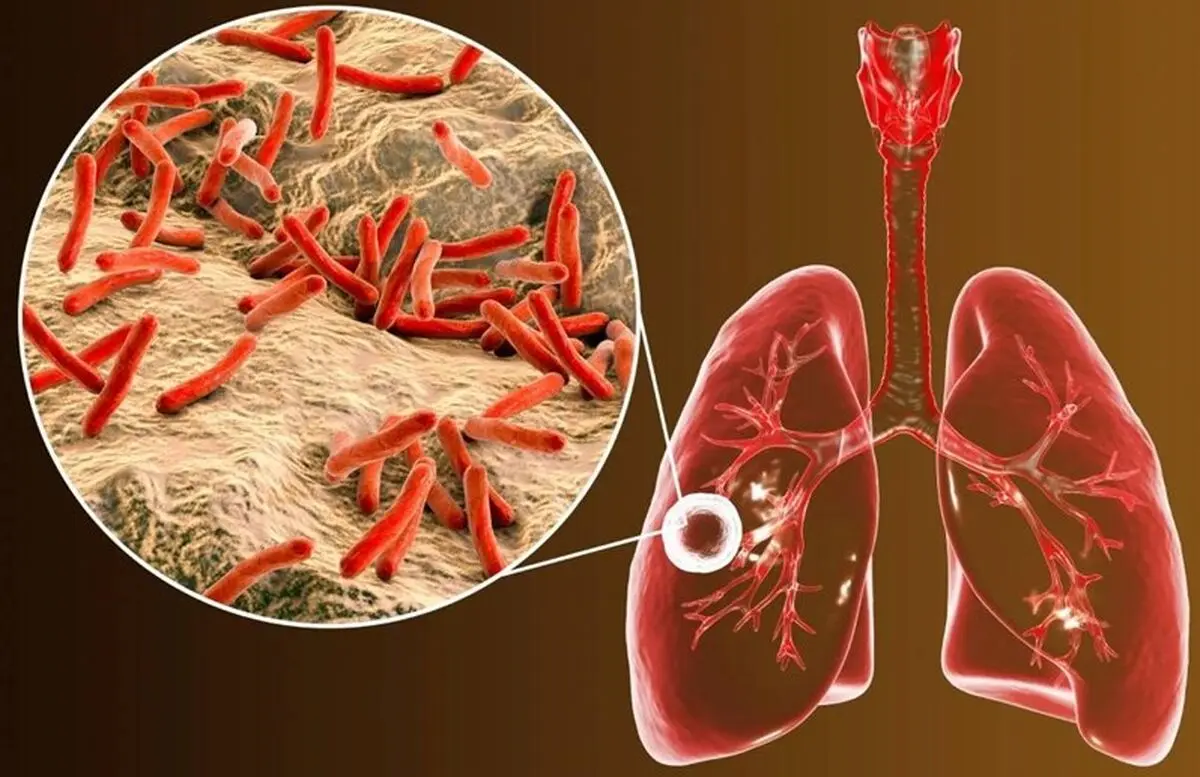 سل: علائم، علل، درمان و نکات پیشگیری