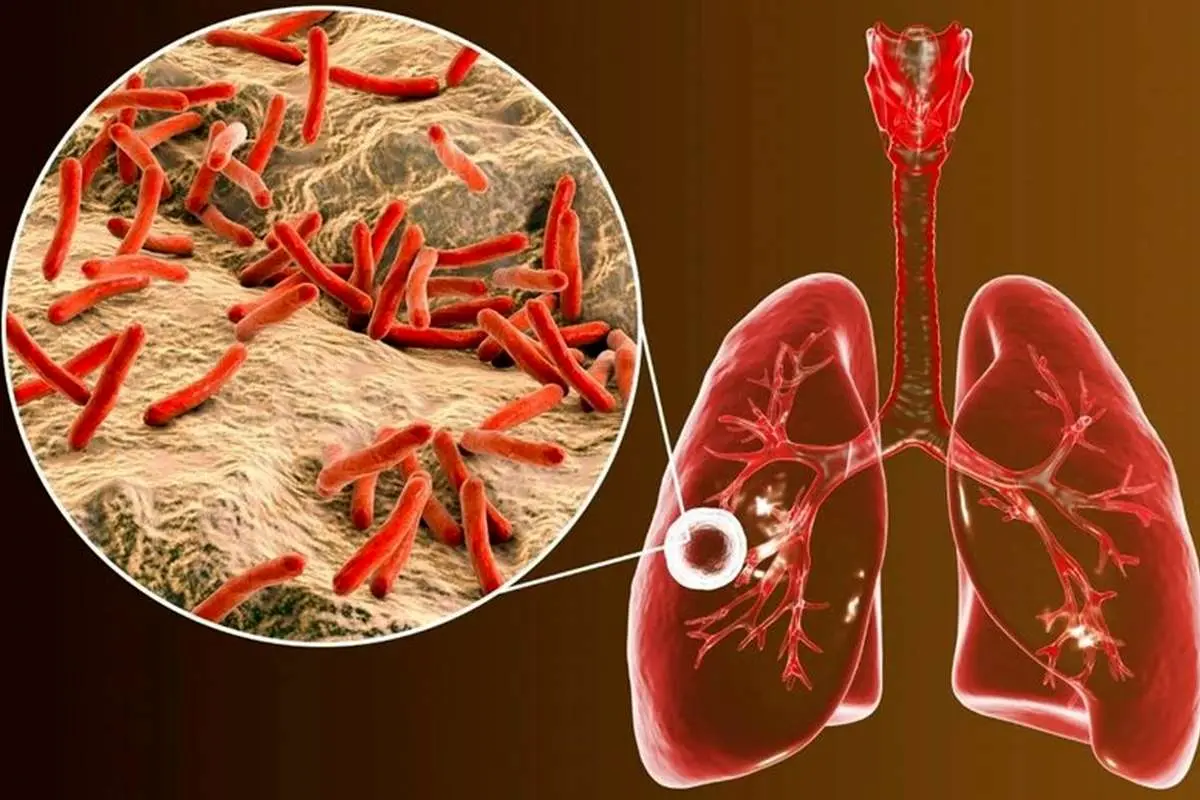 سل: علائم، علل، درمان و نکات پیشگیری