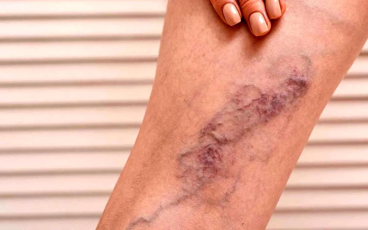 ترومبوز ورید عمقی (DVT): علائم، علل و درمان