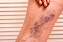 ترومبوز ورید عمقی (DVT): علائم، علل و درمان