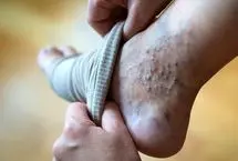 ترومبوفلبیت: علل، علائم، و راه‌های پیشگیری و درمان