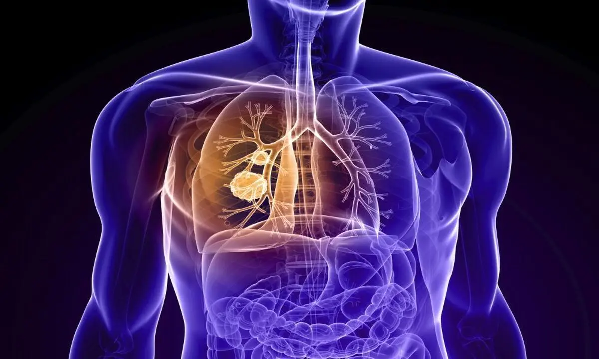 بیماری انسداد ریوی مزمن (COPD)