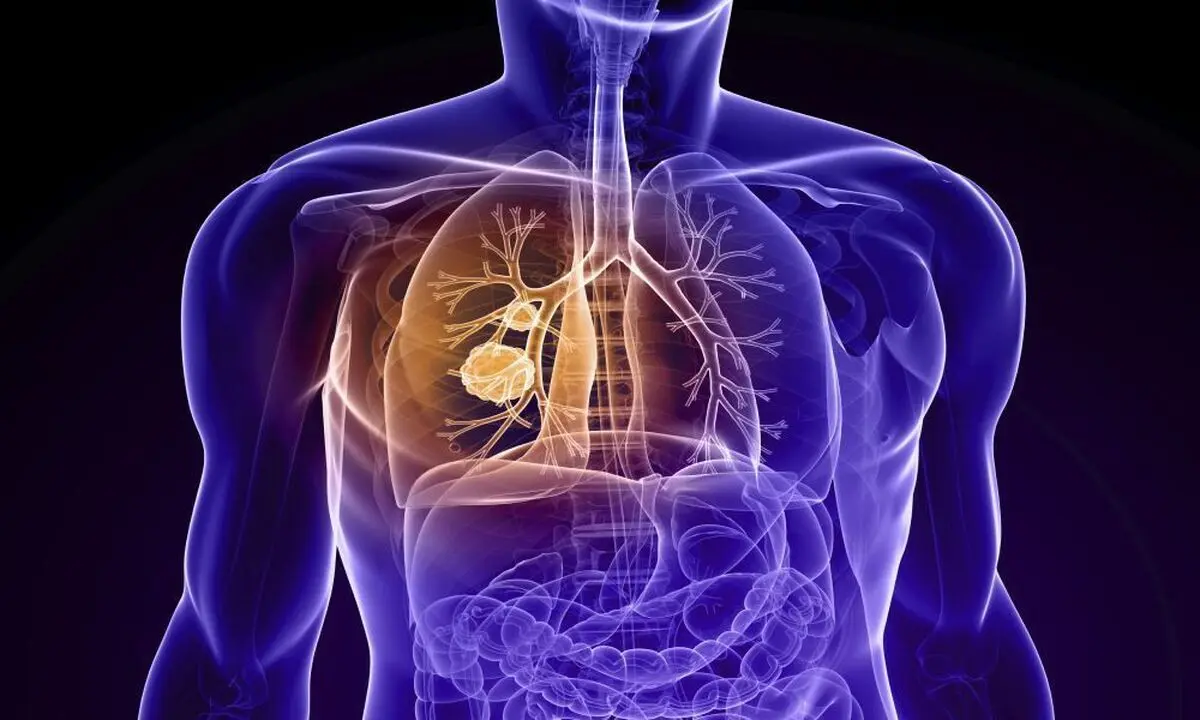بیماری انسداد ریوی مزمن (COPD)