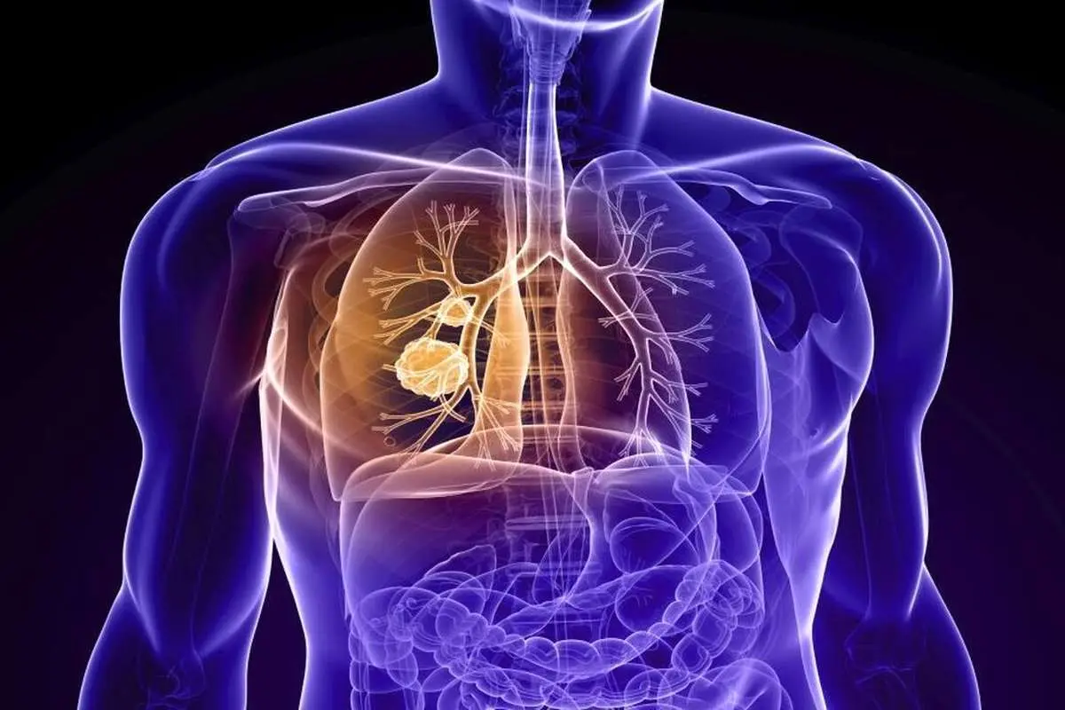 بیماری انسداد ریوی مزمن (COPD)