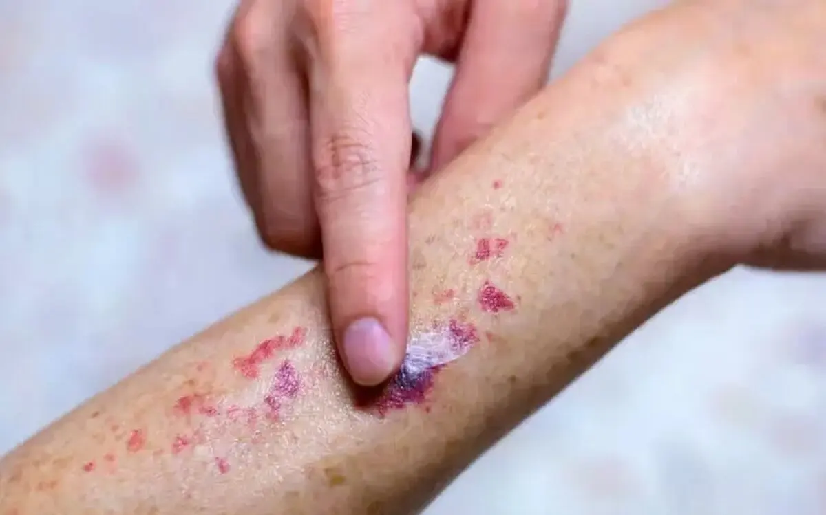 پورپورای آلرژیک؛ علائم، علل و درمان