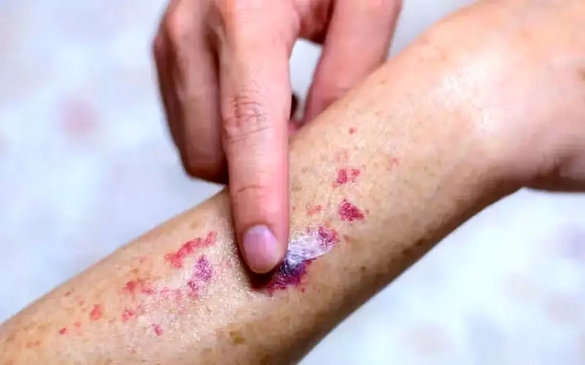 پورپورای آلرژیک؛ علائم، علل و درمان