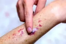 پورپورای آلرژیک؛ علائم، علل و درمان