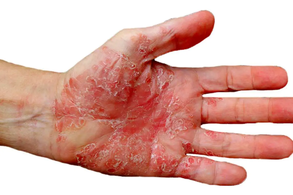 پسوریازیس: راهنمای کامل برای درک، پیشگیری و درمان