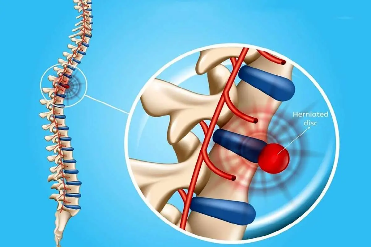 پارگی و بیرونزدگی دیسک بین مهرهای