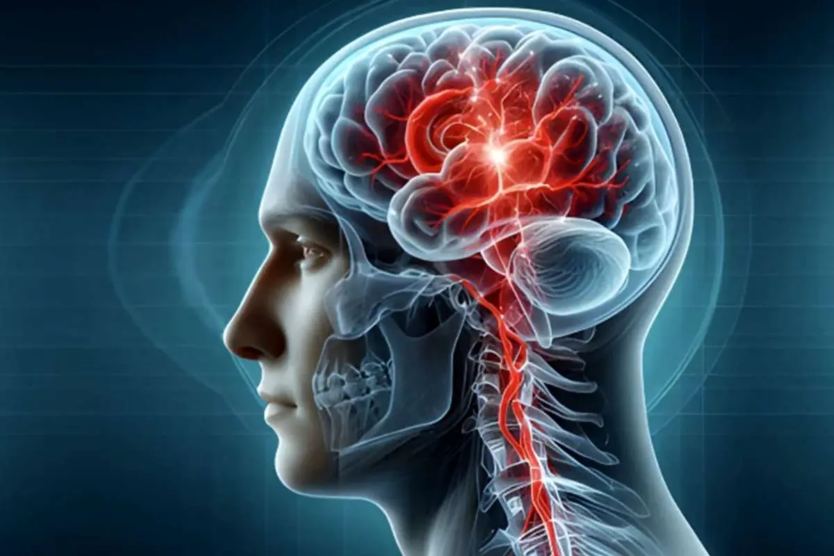 حمله ایسکمیک گذرا (TIA): علائم، علل، پیشگیری و درمان