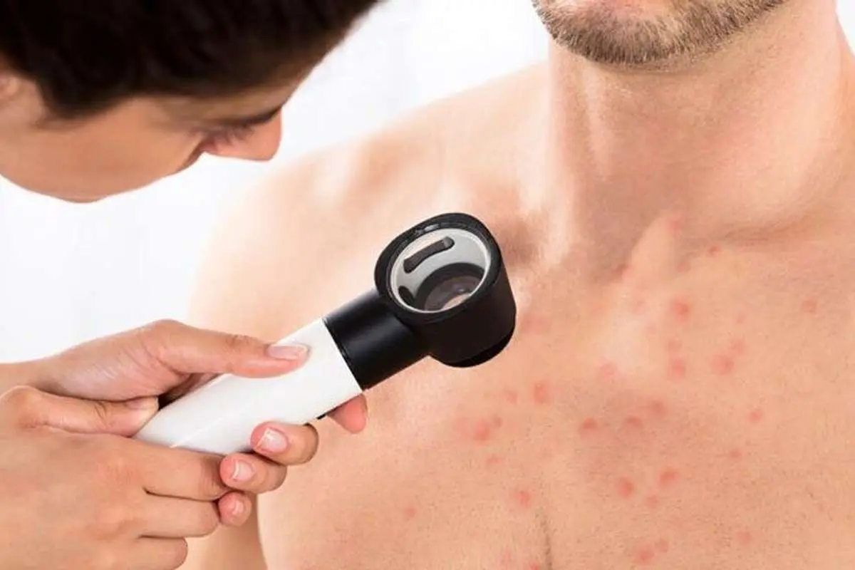 جوش روی قفسه سینه: علل، درمان و پیشگیری