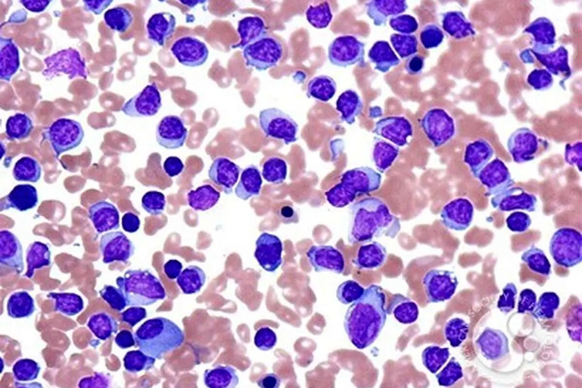 لوسمی لنفوسیتی یا سرطان خون چیست؟