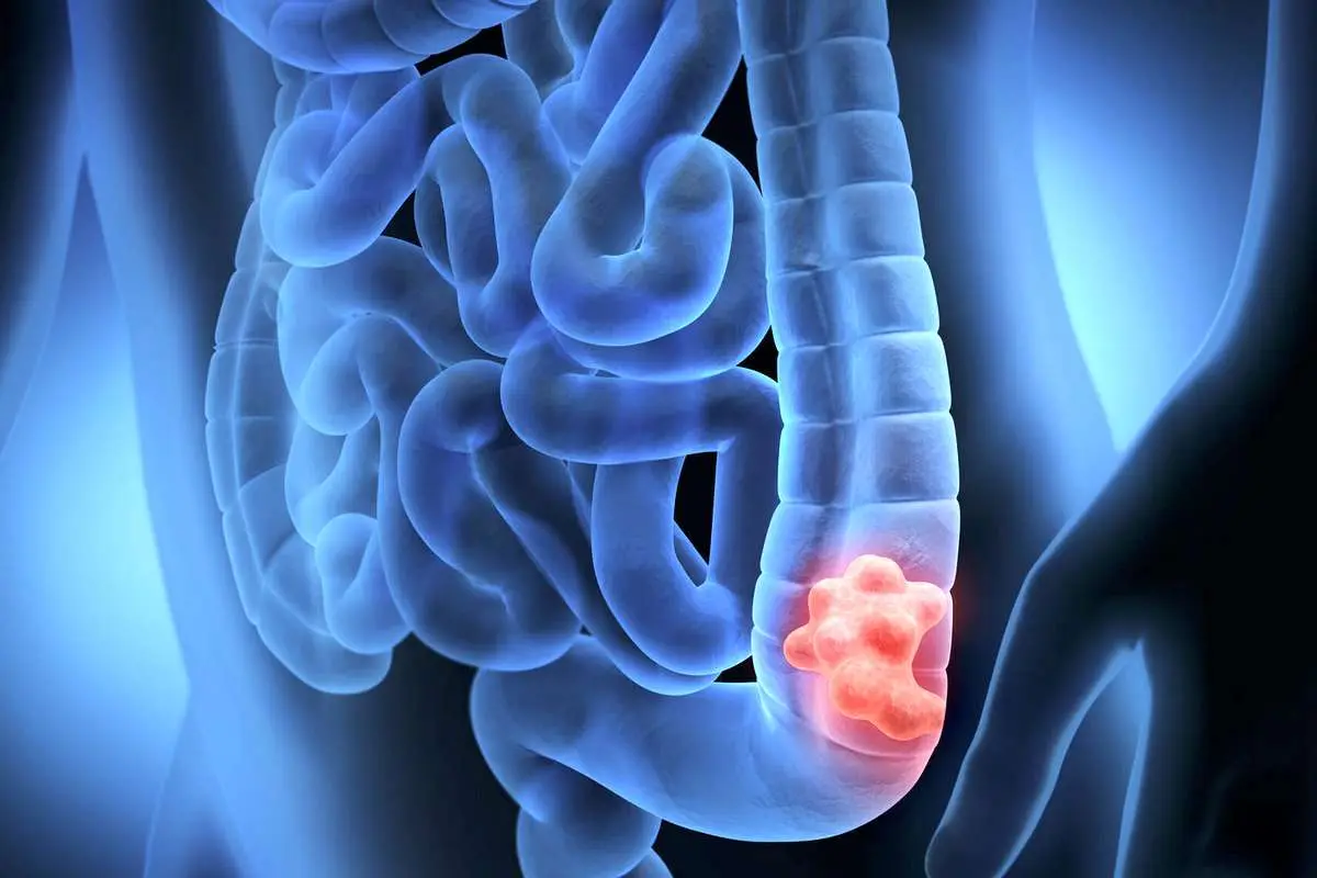 علائم سرطان روده بزرگ / راه‌های پیشگیری