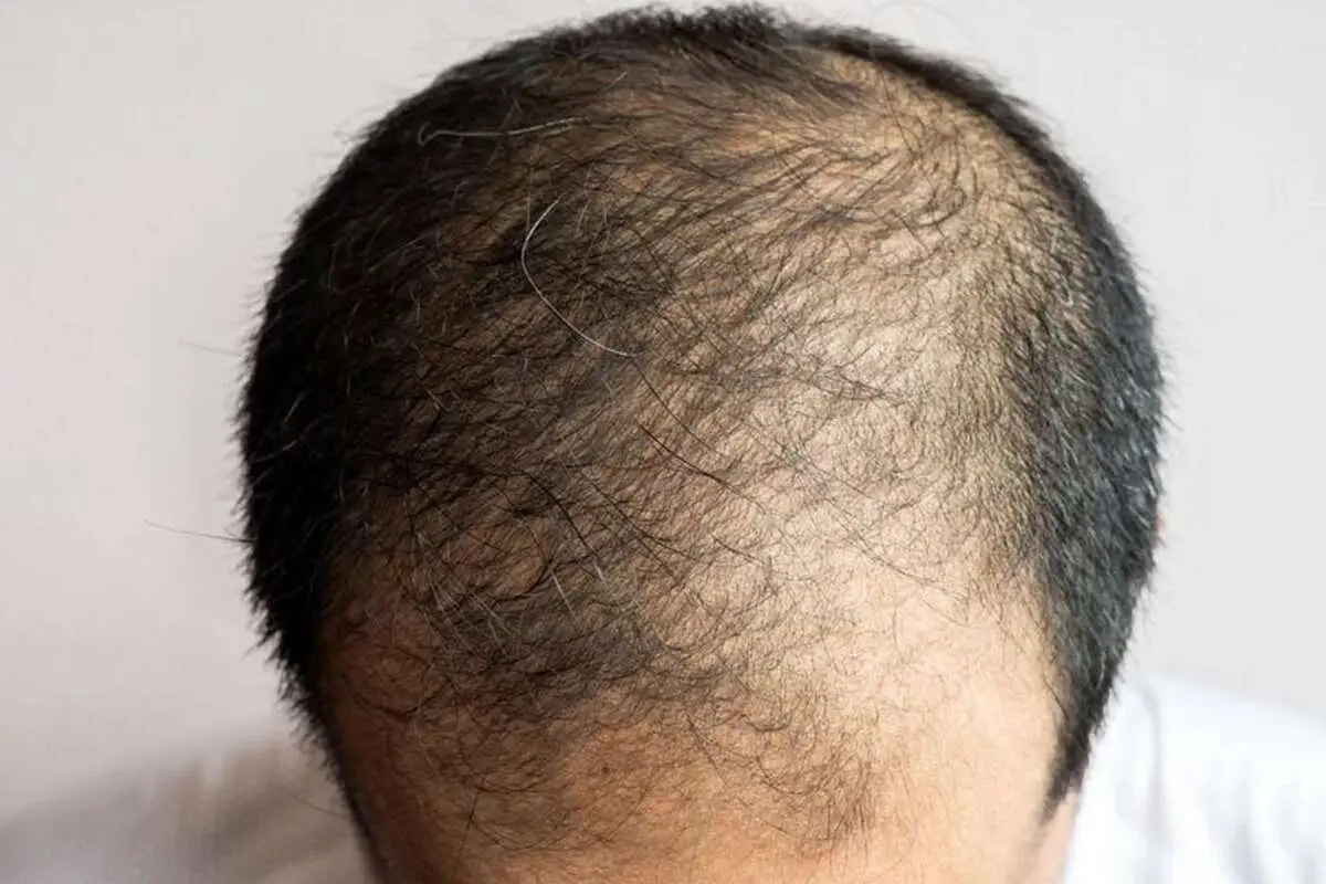 چند راهکار خانگی برای رشد مجدد موهای ریخته شده