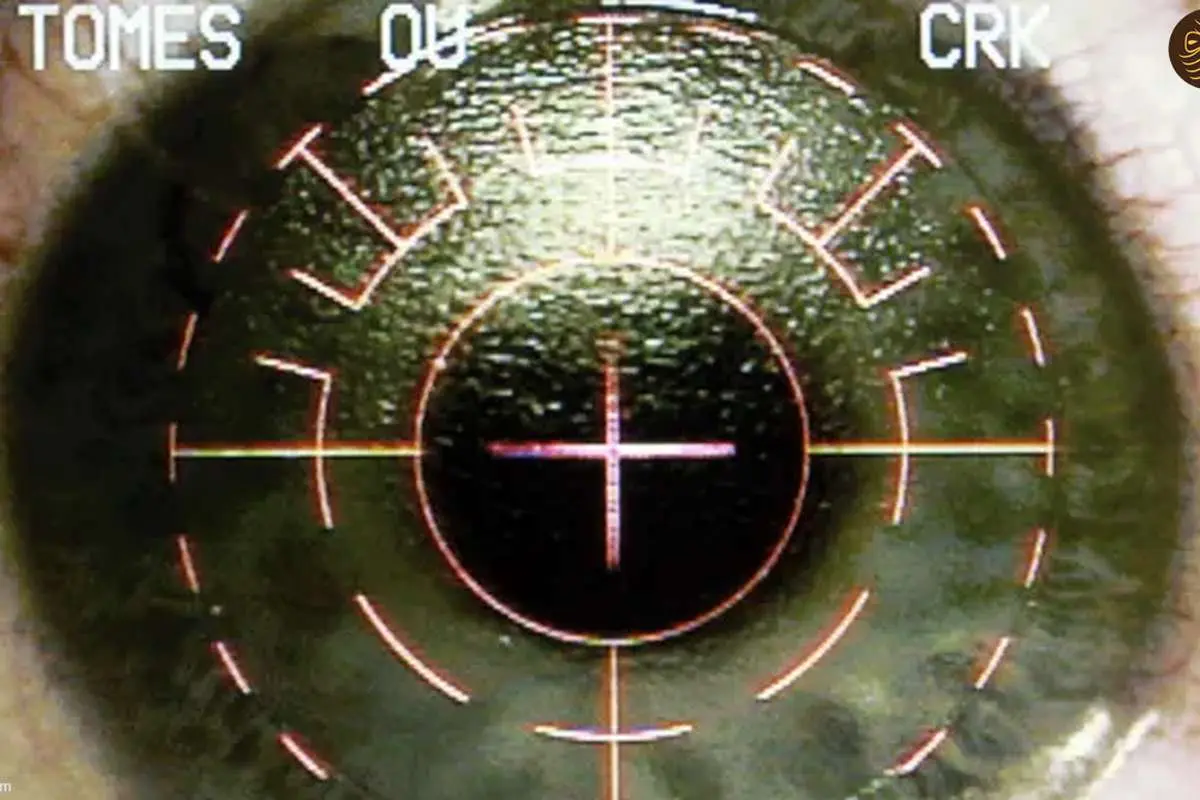 بیمارانی که از جراحی لیزر چشم پشیمان هستند: زندگی من از آن زمان متوقف شده است