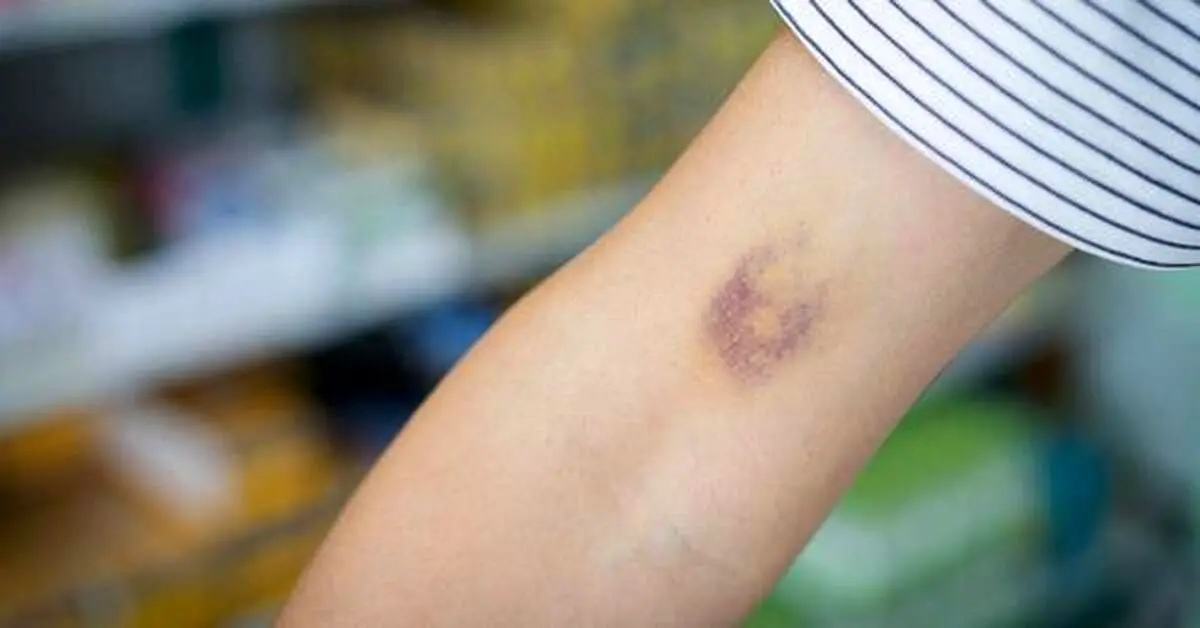 کبودی‌های پوست در چه مواردی غیر طبیعی هستند؟