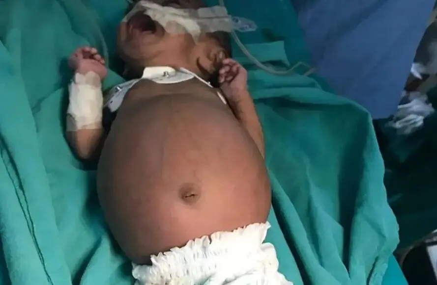 تولد نوزادی که در شکمش جنین دوقلوی خود را داشت