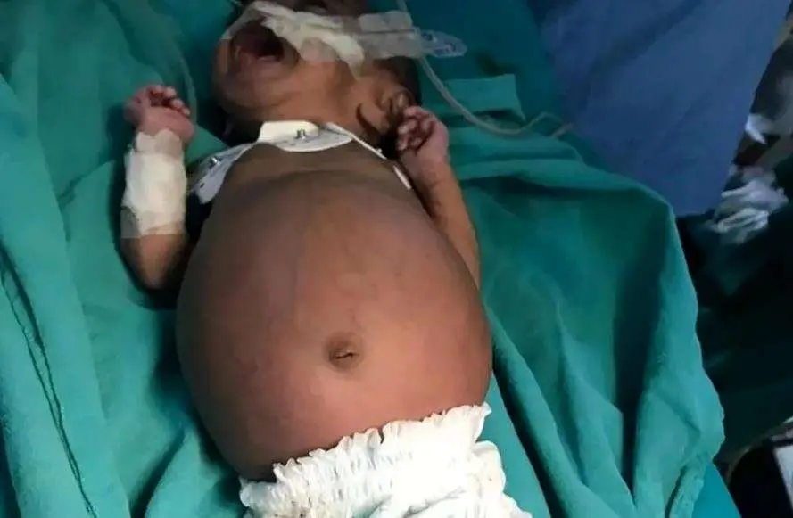 تولد نوزادی که در شکمش جنین دوقلوی خود را داشت