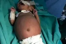 تولد نوزادی که در شکمش جنین دوقلوی خود را داشت