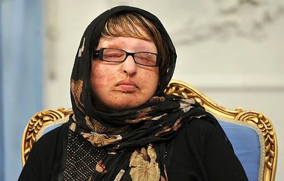 آمنه بهرامی؛ قربانی معروف اسیدپاشی بعد از ۱۸ سال دوباره شکایت کرد/ پشیمانم که بخشیدم!