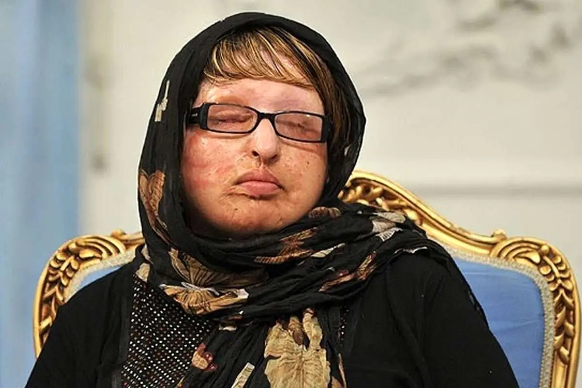 آمنه بهرامی؛ قربانی معروف اسیدپاشی بعد از ۱۸ سال دوباره شکایت کرد/ پشیمانم که بخشیدم!