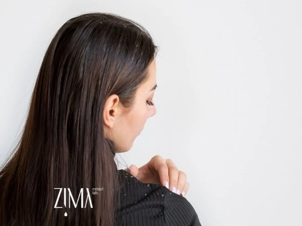 علت شوره سر با معرفی روش درمان