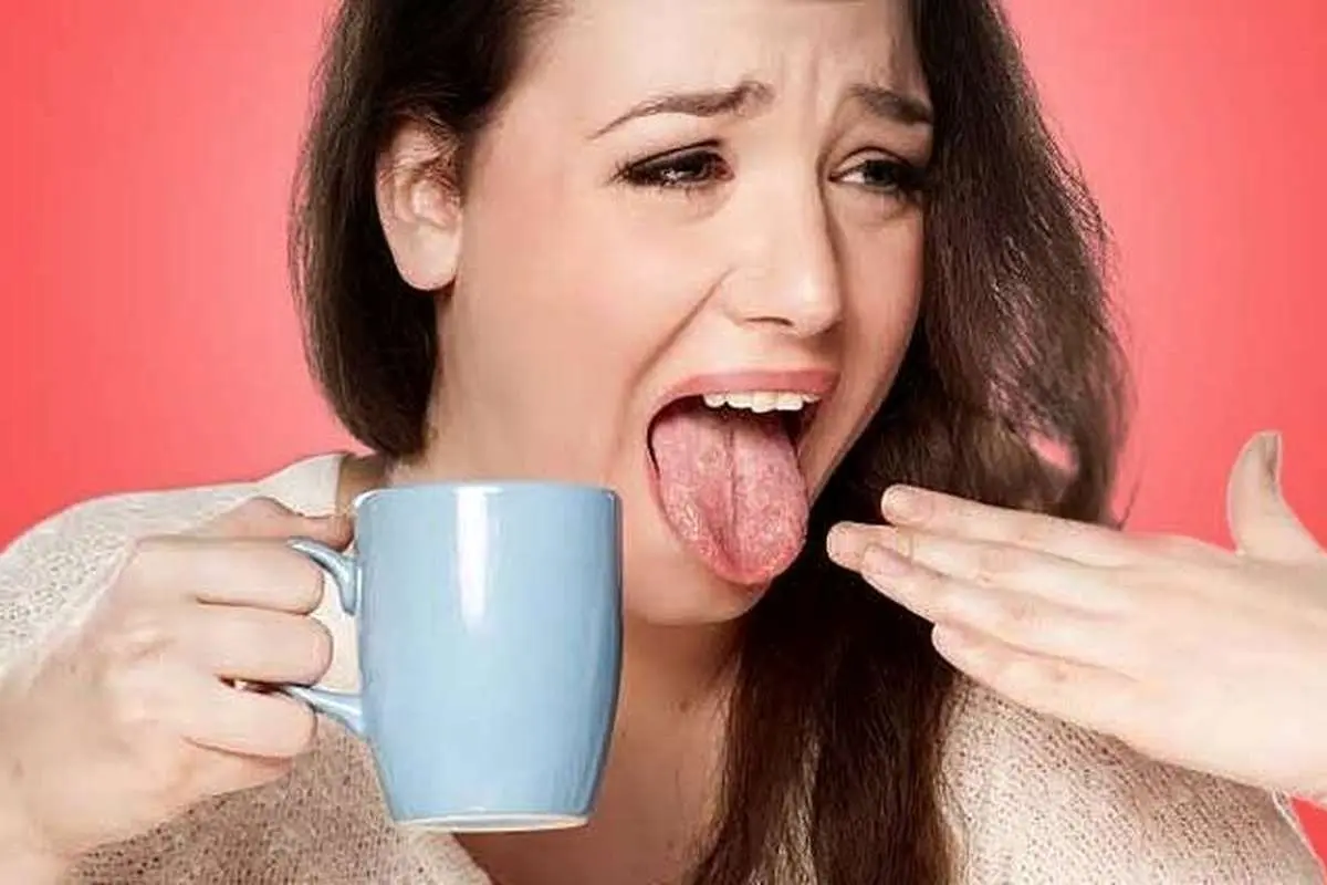 چگونه سوختگی زبان را به سرعت درمان کنیم؟