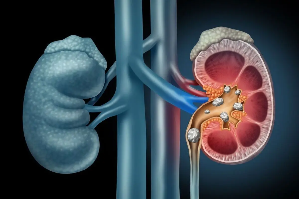 این نوشیدنی سه سوته سنگ کلیه را پودر می‌کند/ درمان فوری سنگ کلیه با هندوانه پخته