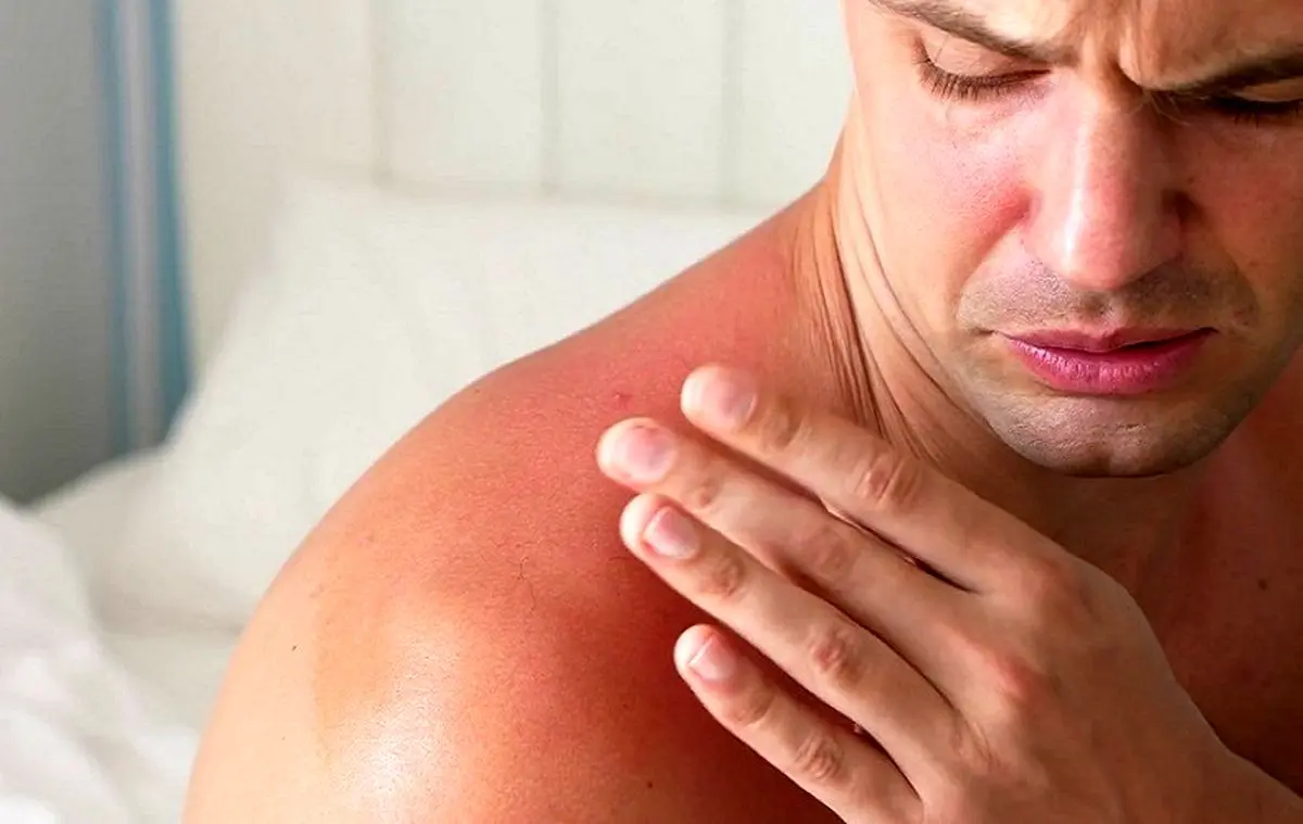 آفتاب‌سوختگی چقدر می‌ماند و چطور التیامش دهیم؟