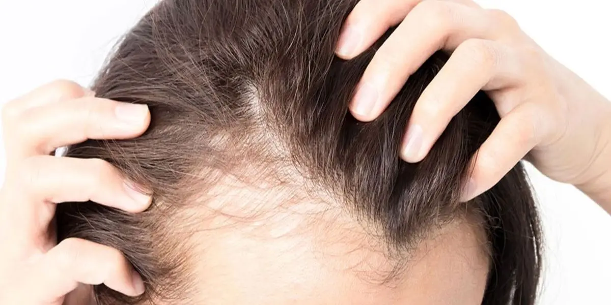 جلوگیری از ریزش مو با این توصیه ساده طب‌سنتی