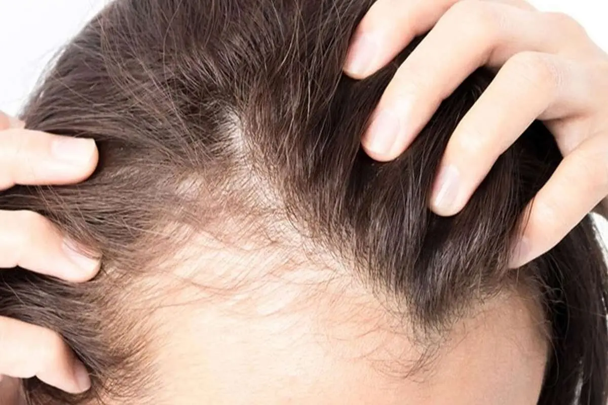جلوگیری از ریزش مو با این توصیه ساده طبسنتی